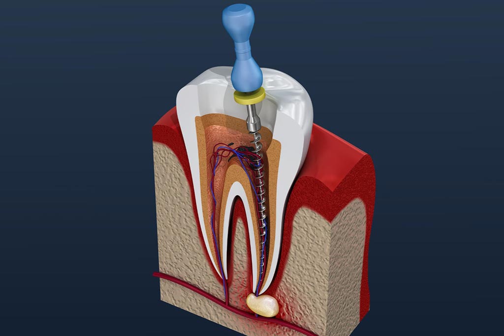 How Do You Know if You Need a Root Canal