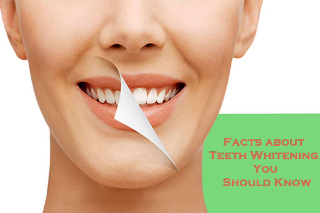 Facts about Teeth Whitening You Should Know